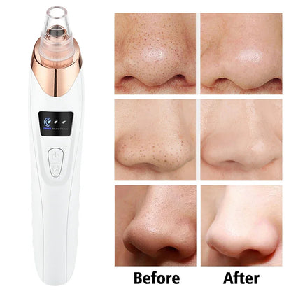 5in1 Rechargeable Blackhead Remover and Vacuum Suction Acne Pore Cleaner Essencify