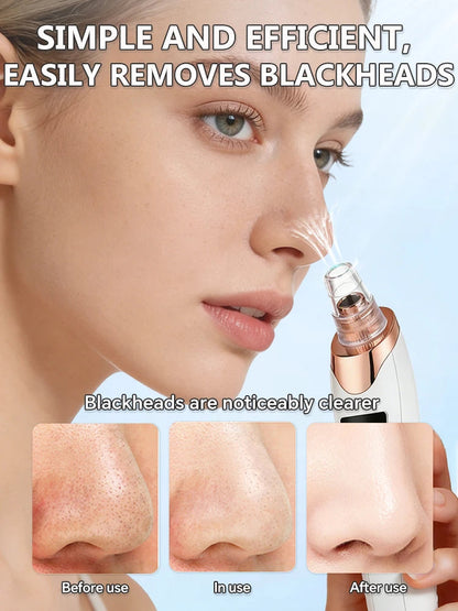 5in1 Rechargeable Blackhead Remover and Vacuum Suction Acne Pore Cleaner Essencify